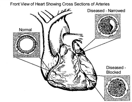 Coronary Artery Disease Coronary Artery Disease